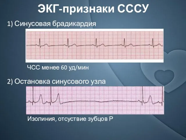 ЭКГ-признаки СССУ 1) Синусовая брадикардия ЧСС менее 60 уд/мин 2)