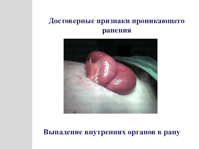 Достоверные признаки проникающего ранения Выпадение внутренних органов в рану