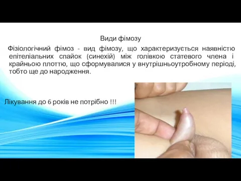 Види фімозу Фізіологічний фімоз - вид фімозу, що характеризується наявністю