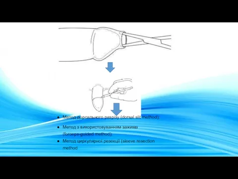 Метод дорсального разрізу (dorsal slit method); Метод з використовуванням зажима