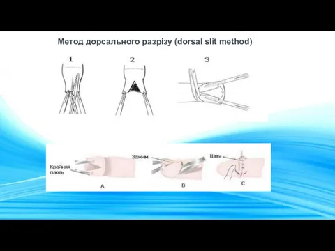 Метод дорсального разрізу (dorsal slit method)