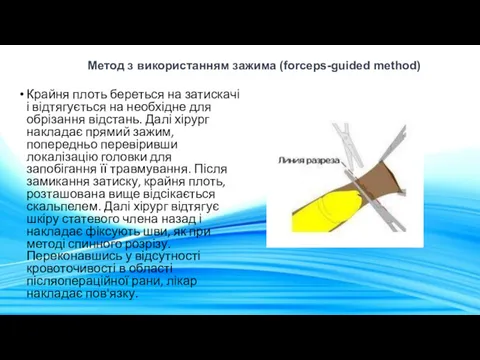 Метод з використанням зажима (forceps-guided method) Крайня плоть береться на