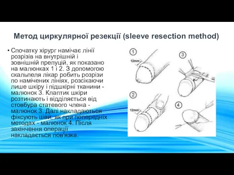 Метод циркулярної резекції (sleeve resection method) Спочатку хірург намічає лінії