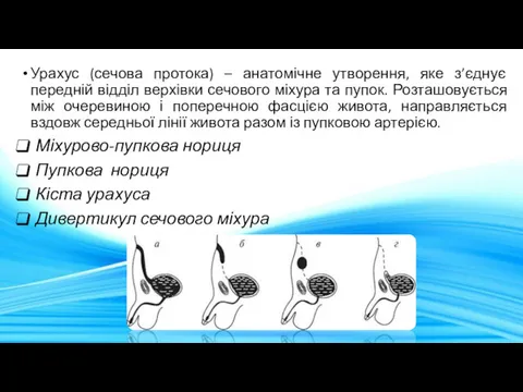 Урахус (сечова протока) – анатомічне утворення, яке з’єднує передній відділ