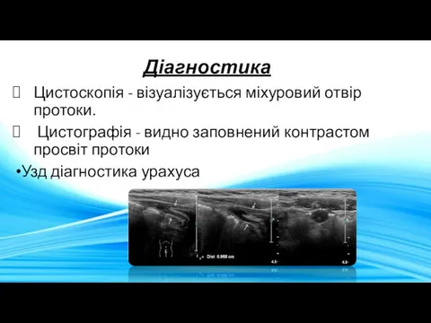 Діагностика Цистоскопія - візуалізується міхуровий отвір протоки. Цистографія - видно