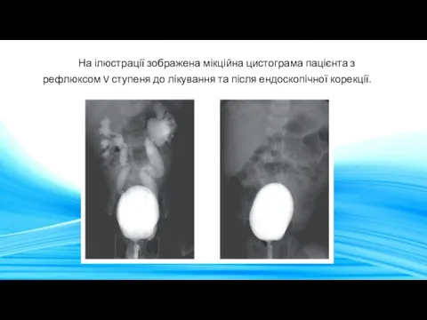 На ілюстрації зображена мікційна цистограма пацієнта з рефлюксом V ступеня до лікування та після ендоскопічної корекції.