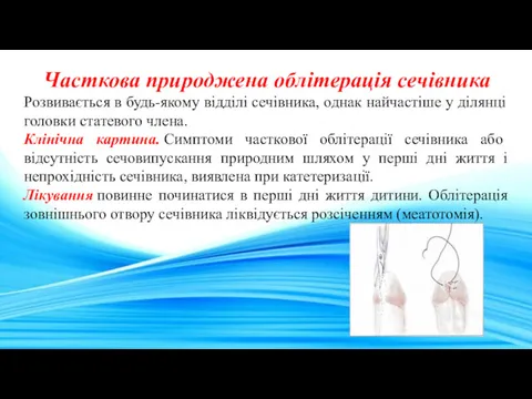 Часткова природжена облітерація сечівника Розвивається в будь-якому відділі сечівника, однак