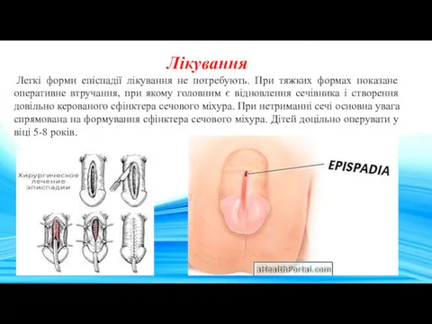 Лікування Легкі форми епіспадії лікування не потребують. При тяжких формах