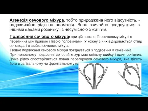 Агенезія сечового міхура, тобто природжена його відсутність, -надзвичайно рідкісна аномалія.