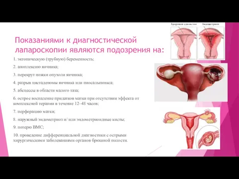 Показаниями к диагностической лапароскопии являются подозрения на: 1. эктопическую (трубную) беременность; 2. апоплексию