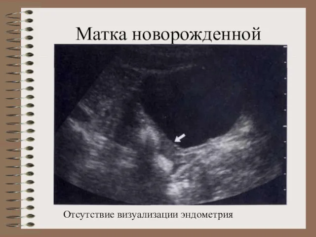 Матка новорожденной Отсутствие визуализации эндометрия