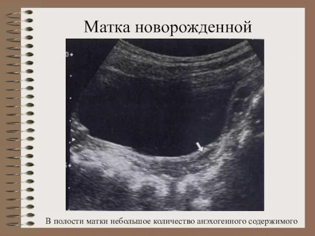 Матка новорожденной В полости матки небольшое количество анэхогенного содержимого