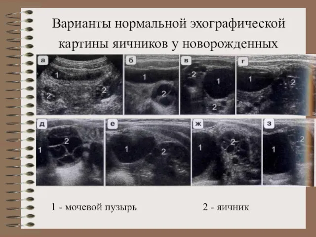 Варианты нормальной эхографической картины яичников у новорожденных 1 - мочевой пузырь 2 - яичник