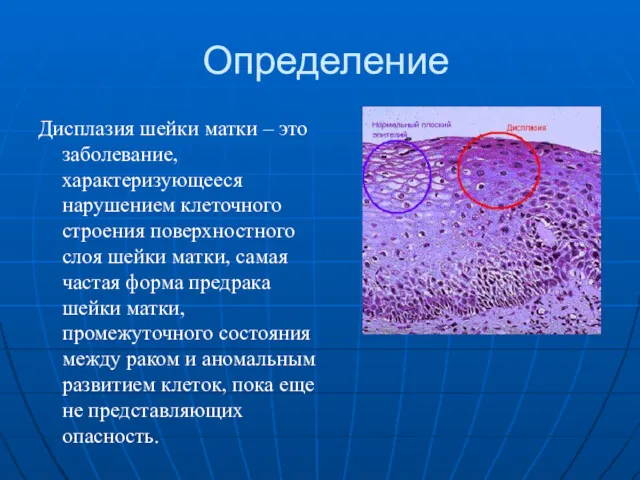Определение Дисплазия шейки матки – это заболевание, характеризующееся нарушением клеточного