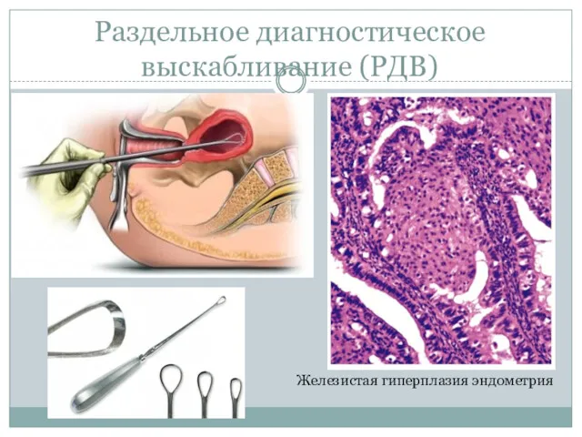 Раздельное диагностическое выскабливание (РДВ) Железистая гиперплазия эндометрия