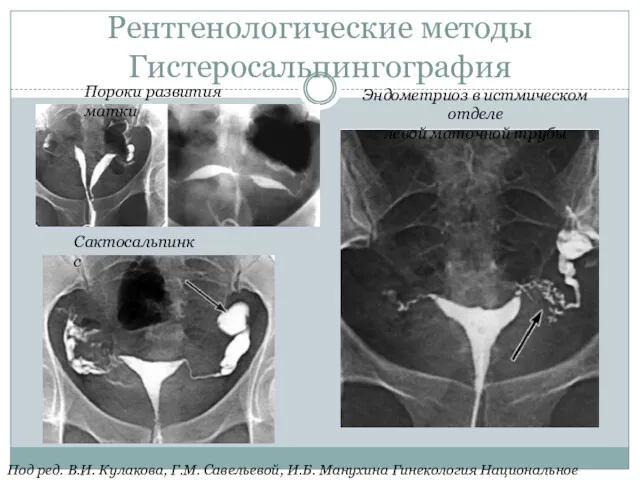 Рентгенологические методы Гистеросальпингография Пороки развития матки Сактосальпинкс Эндометриоз в истмическом отделе левой маточной