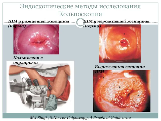 Эндоскопические методы исследования Кольпоскопия Кольпоскоп с окулярами ШМ у нерожавшей