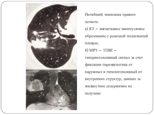 Погибший эхинококк правого легкого: а) КТ – мягкотканое многоузловое образование