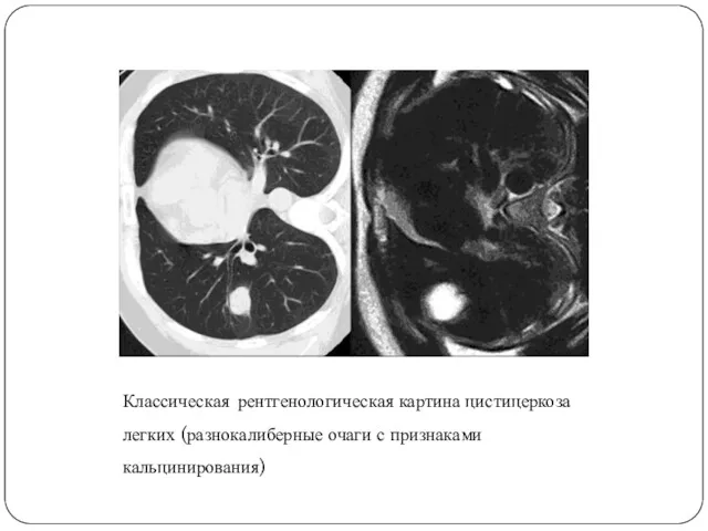 Классическая рентгенологическая картина цистицеркоза легких (разнокалиберные очаги с признаками кальцинирования)