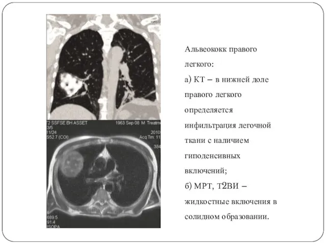 Альвеококк правого легкого: а) КТ – в нижней доле правого