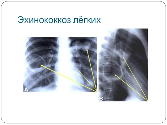 Эхинококкоз лёгких