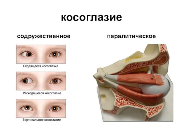 косоглазие содружественное паралитическое