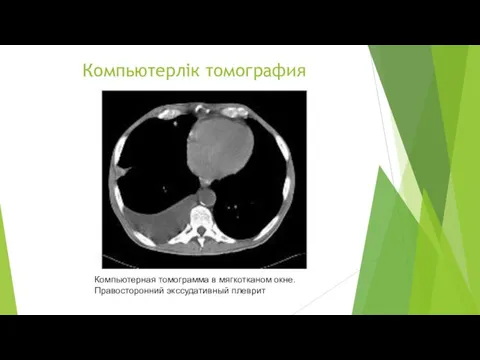 Компьютерлік томография Компьютерная томограмма в мягкотканом окне. Правосторонний экссудативный плеврит