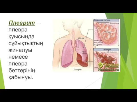 Плеврит — плевра қуысында сұйықтықтың жиналуы немесе плевра беттерінің қабынуы.