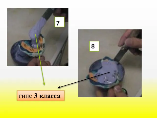 7 8 гипс 3 класса