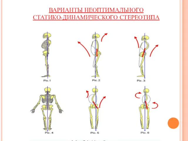 Смещение центра тяжести от вертикальной оси ВАРИАНТЫ НЕОПТИМАЛЬНОГО СТАТИКО-ДИНАМИЧЕСКОГО СТЕРЕОТИПА