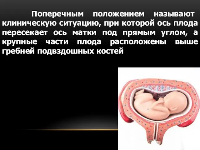 Поперечным положением называют клиническую ситуацию, при которой ось плода пересекает