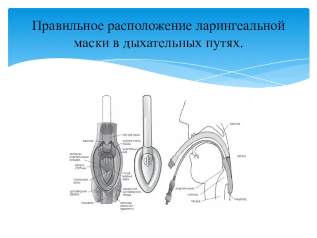 Правильное расположение ларингеальной маски в дыхательных путях.