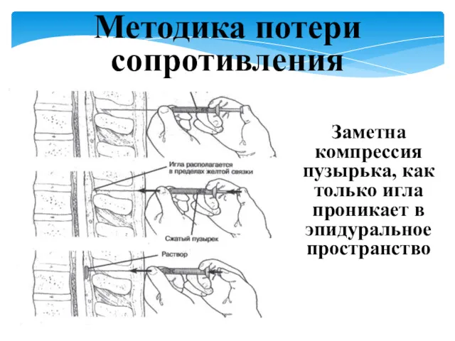 Методика потери сопротивления Заметна компрессия пузырька, как только игла проникает в эпидуральное пространство