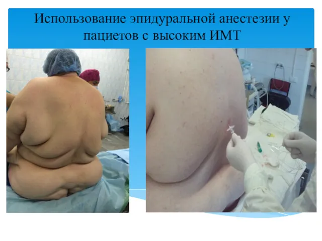 Использование эпидуральной анестезии у пациетов с высоким ИМТ Из архива НИИ онкологии им. Петрова
