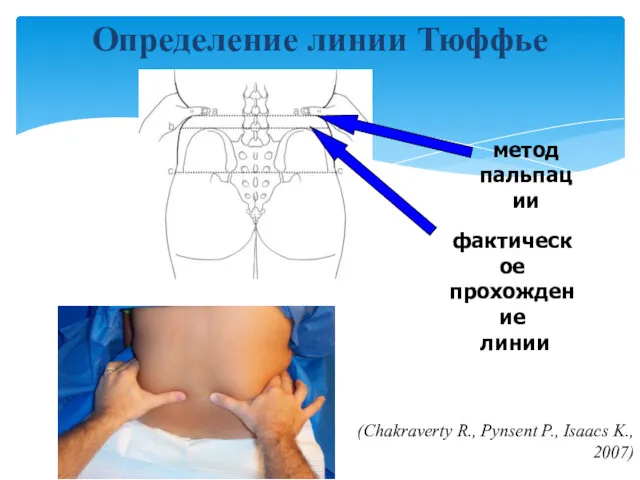 Определение линии Тюффье (Chakraverty R., Pynsent P., Isaacs K., 2007) метод пальпации фактическое прохождение линии