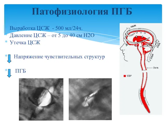 Патофизиология ПГБ Выработка ЦСЖ - 500 мл/24ч. Давление ЦСЖ –