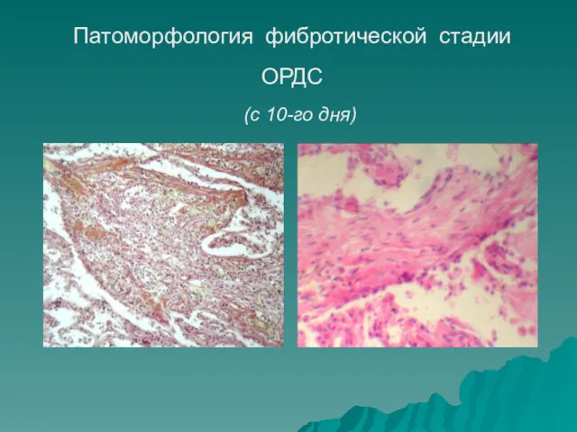 Патоморфология фибротической стадии ОРДС (с 10-го дня)