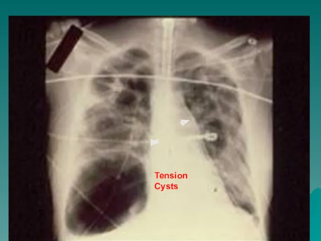 Tension Cysts