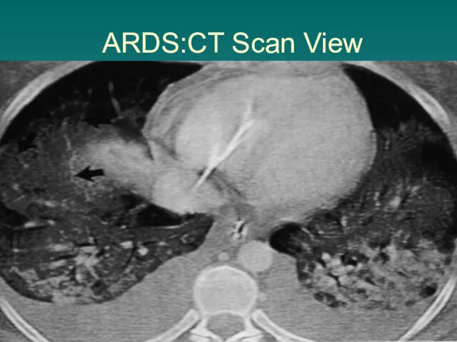 ARDS:CT Scan View