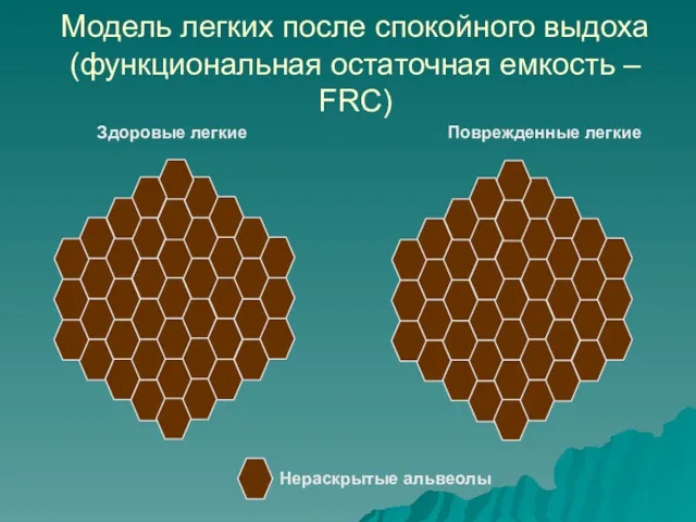 Модель легких после спокойного выдоха (функциональная остаточная емкость – FRC) Нераскрытые альвеолы Здоровые легкие Поврежденные легкие