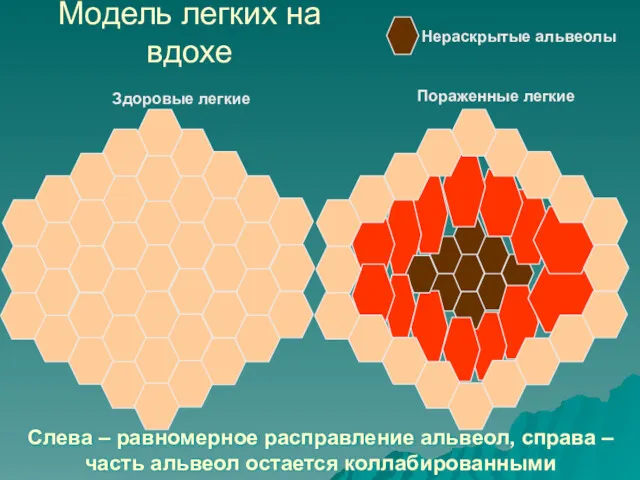 Модель легких на вдохе Нераскрытые альвеолы Здоровые легкие Пораженные легкие