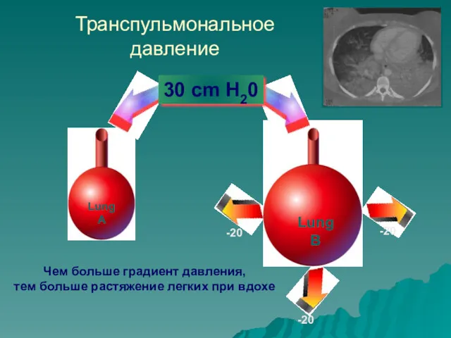 Транспульмональное давление Чем больше градиент давления, тем больше растяжение легких при вдохе 30 cm H20