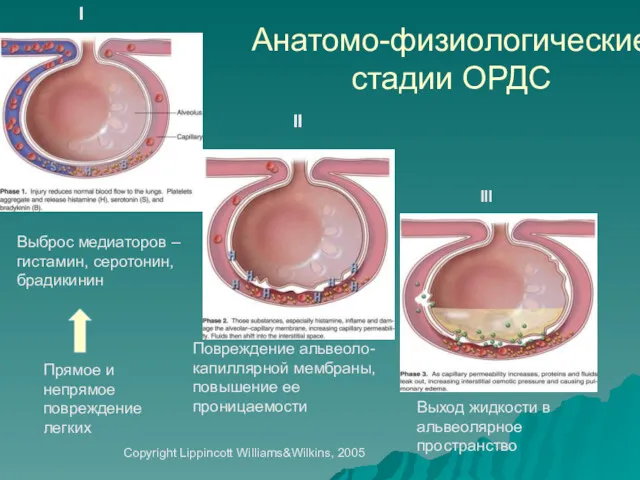 Анатомо-физиологические стадии ОРДС Выброс медиаторов – гистамин, серотонин, брадикинин Повреждение
