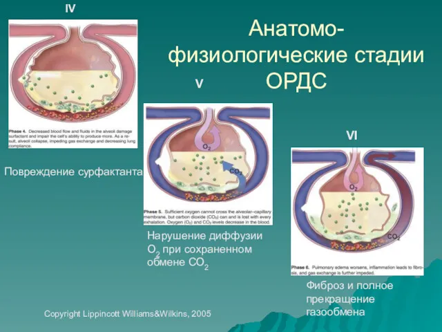 Анатомо-физиологические стадии ОРДС Повреждение сурфактанта Нарушение диффузии О2 при сохраненном