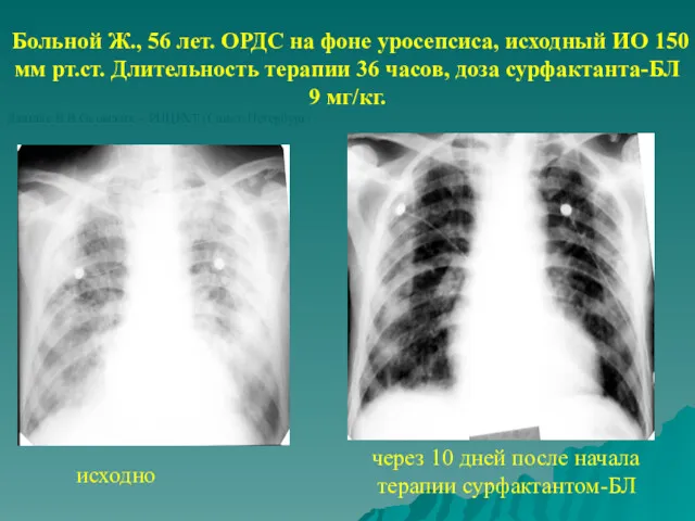 исходно через 10 дней после начала терапии сурфактантом-БЛ Больной Ж.,