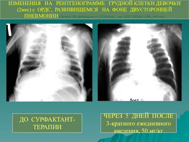 ИЗМЕНЕНИЯ НА РЕНТГЕНОГРАММЕ ГРУДНОЙ КЛЕТКИ ДЕВОЧКИ (2мес) с ОРДС, РАЗВИВИШЕМСЯ