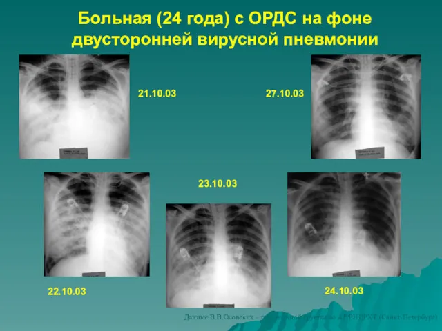 Больная (24 года) с ОРДС на фоне двусторонней вирусной пневмонии