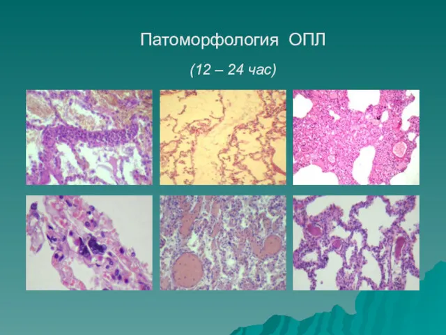 Патоморфология ОПЛ (12 – 24 час)