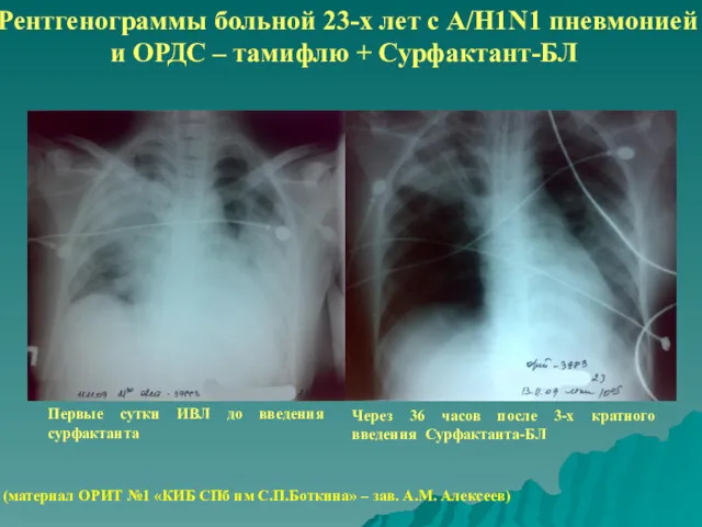 Рентгенограммы больной 23-х лет с A/H1N1 пневмонией и ОРДС –