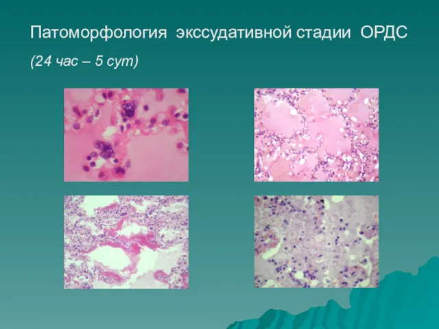 Патоморфология экссудативной стадии ОРДС (24 час – 5 сут)